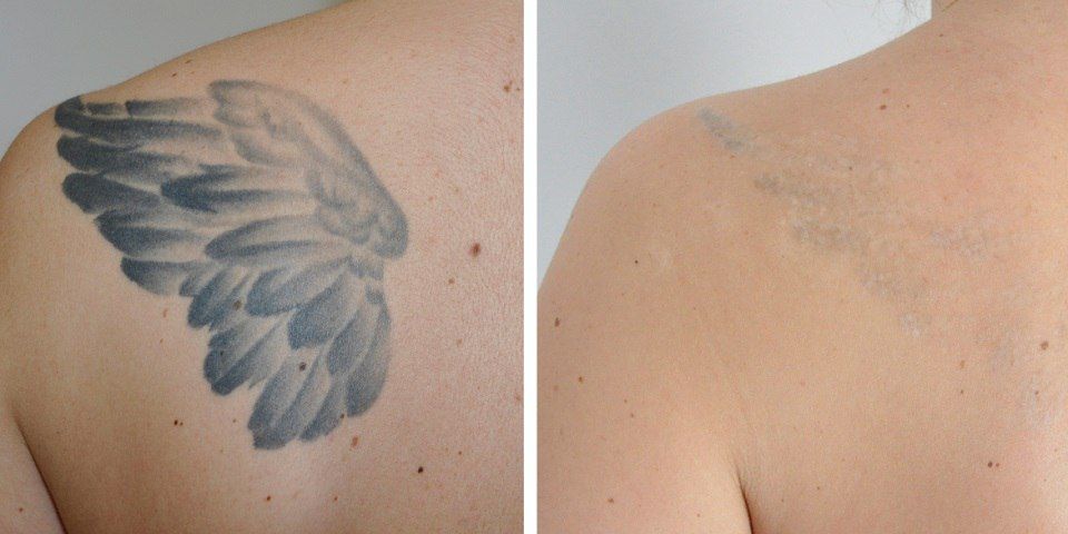 Удаление татуировок - клиника лазерной косметологии в Москве