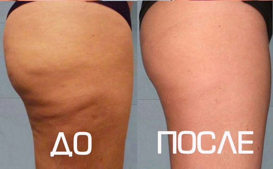 Вакуумный массаж Вакуумный массаж