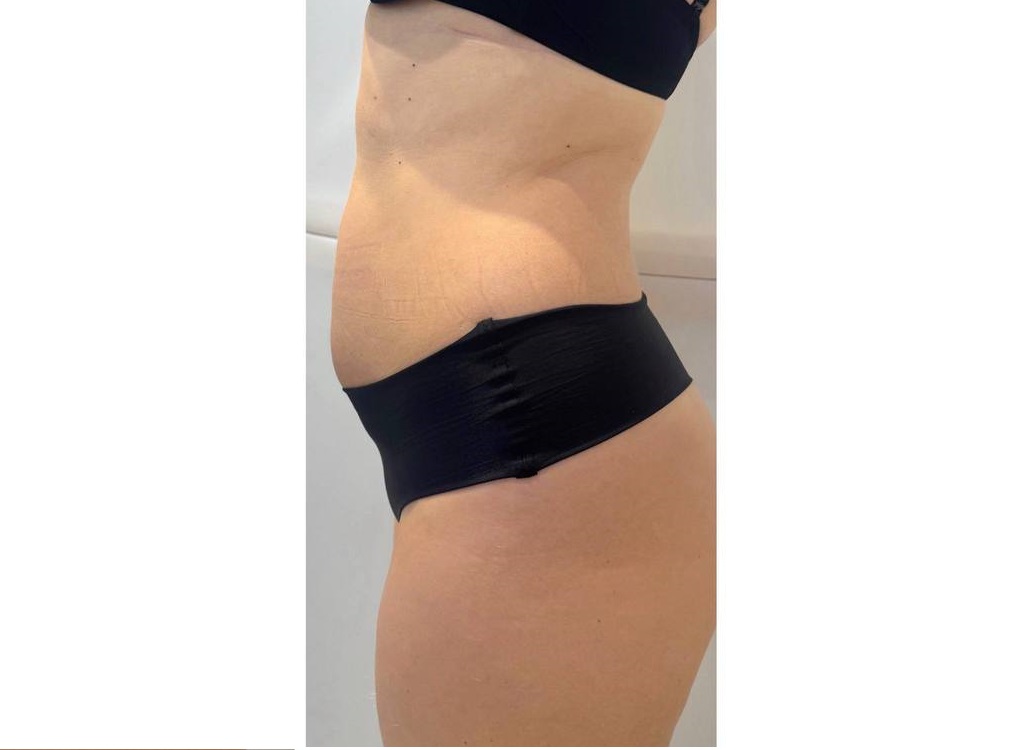 Коррекция живота