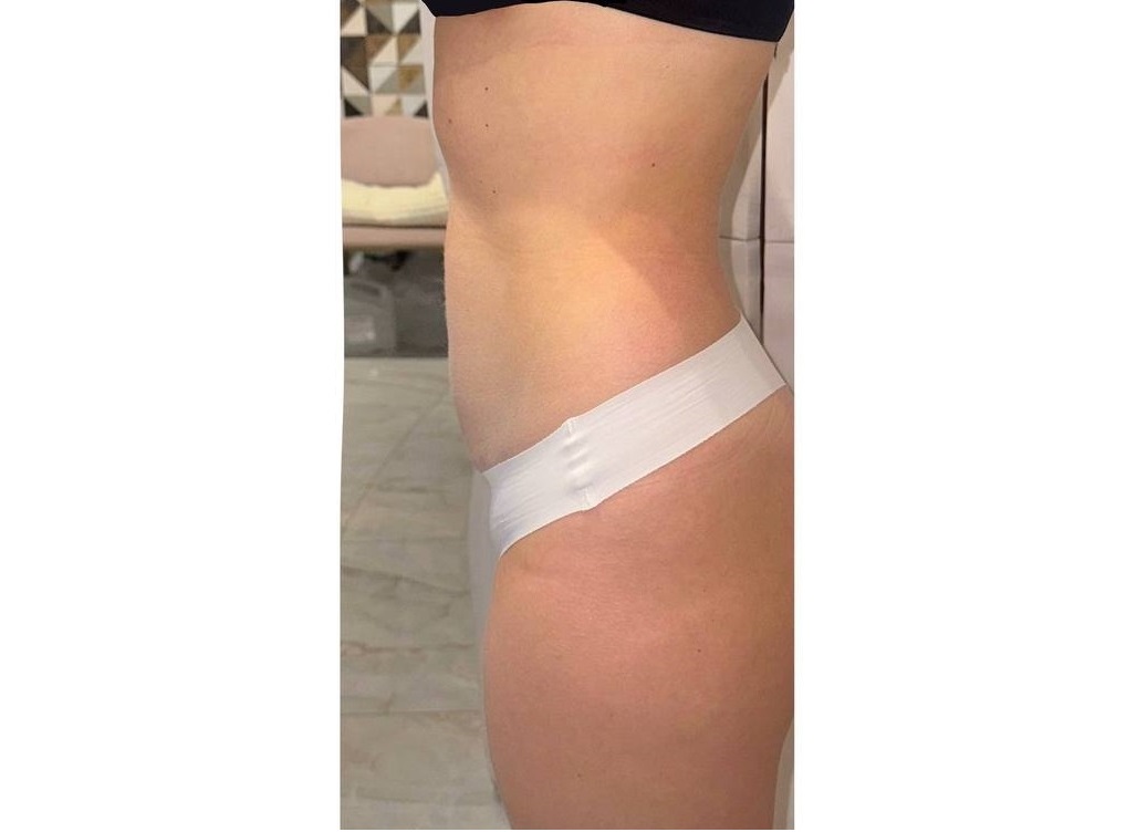 Коррекция живота