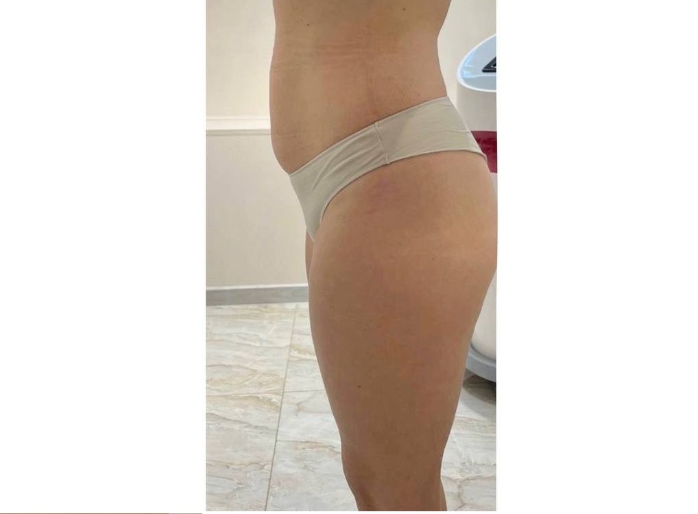 Коррекция живота