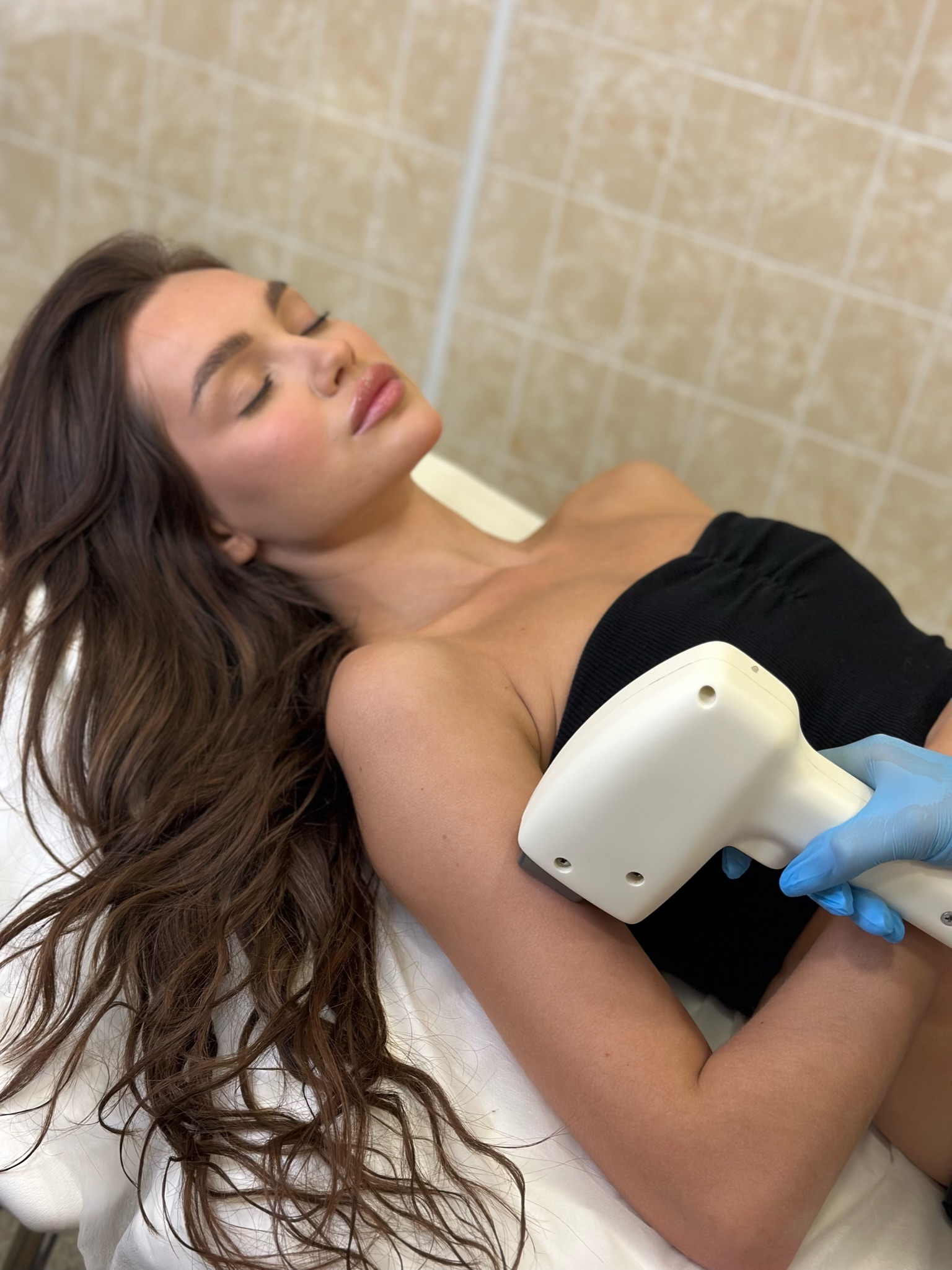 Лазерная эпиляция