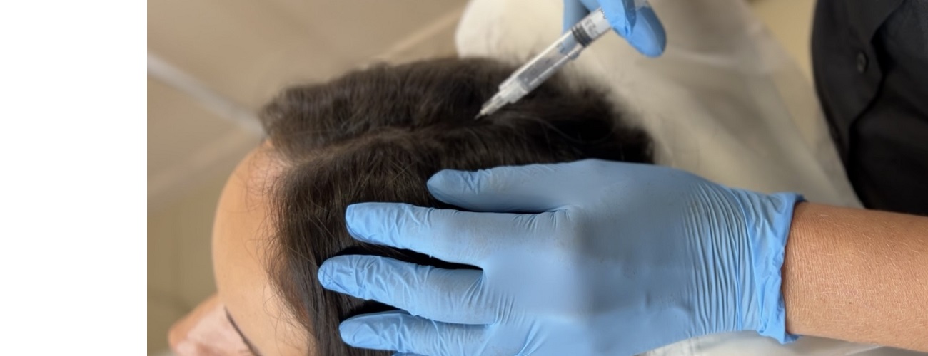 Плазмотерапия кожи головы