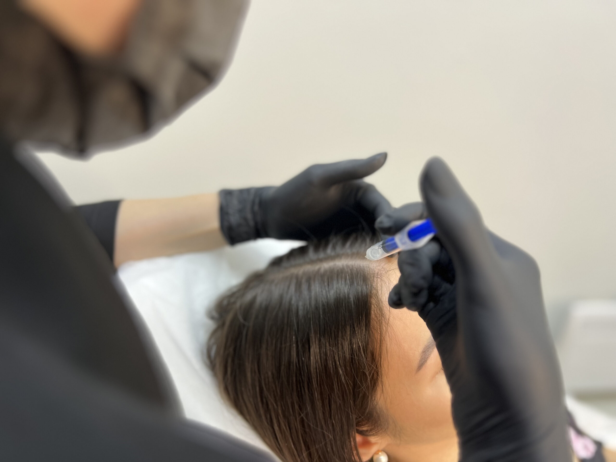 Плазмотерапия кожи головы 1