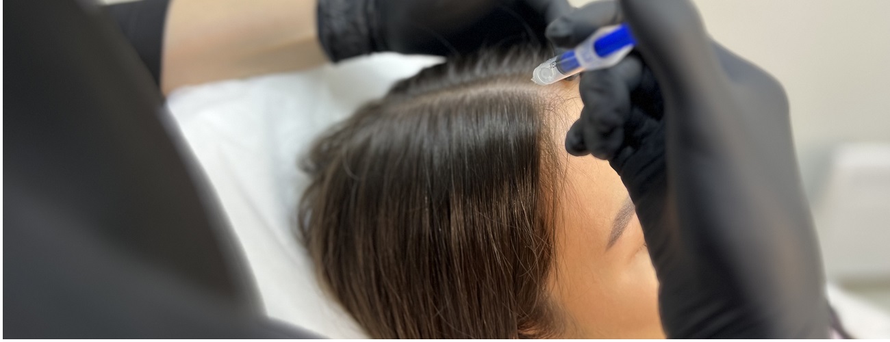 Очаговая алопеция (ареата)