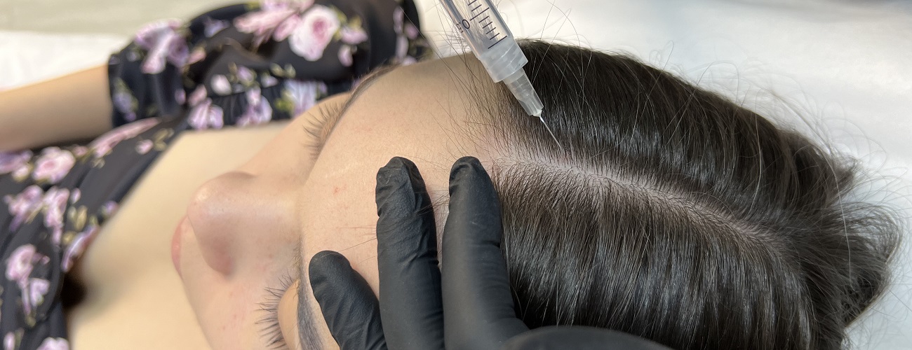 Телогеновое выпадение волос (послеродовое выпадение, диффузная алопеция)