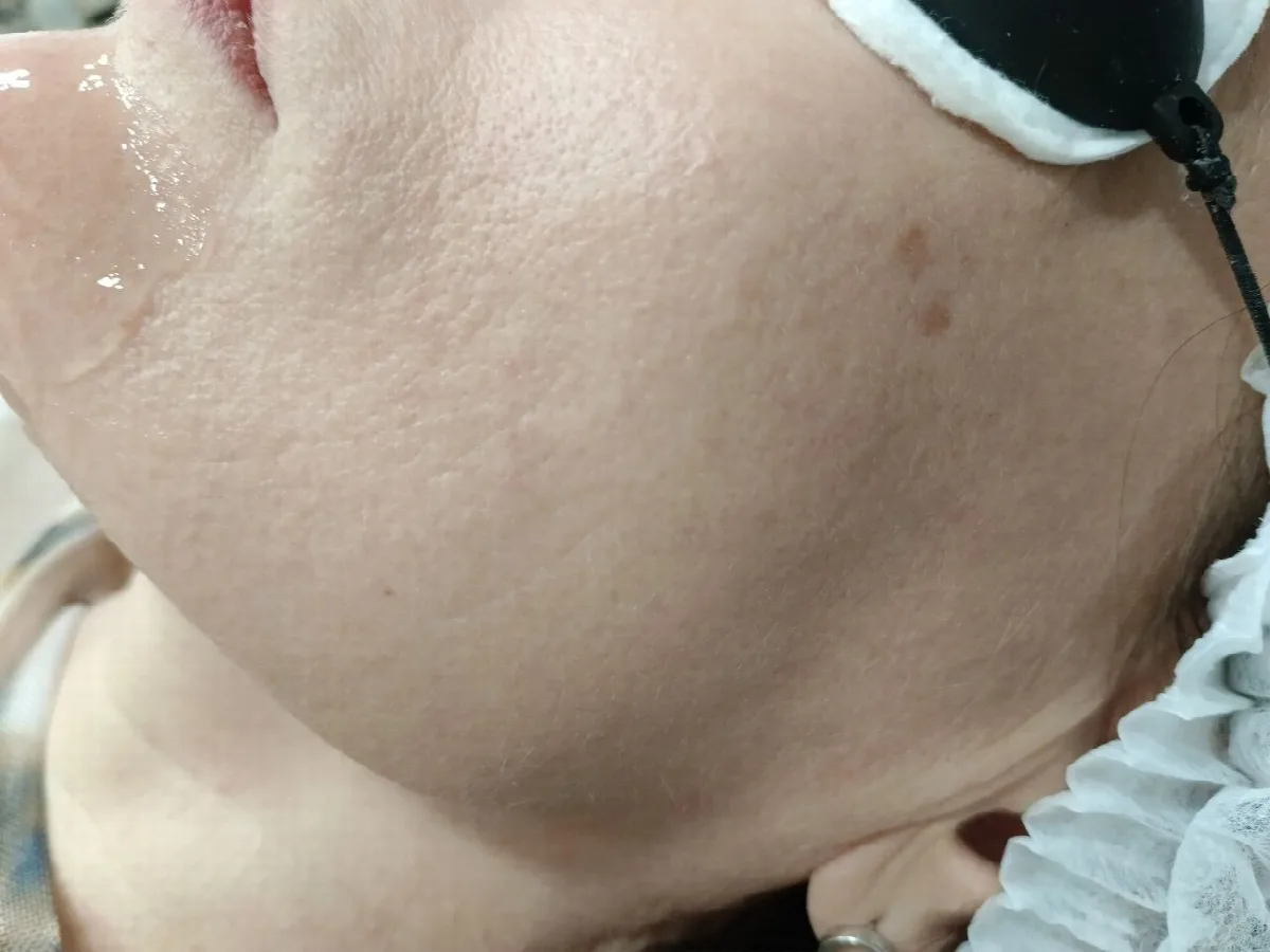 После фотоомоложения: Неровный тон и пигментация